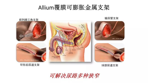 国内最新输尿管覆膜支架手术，解除小便难的困扰-精研拍拍网